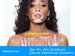 Vitiligo Nedir: Belirtileri ve Tedavisi