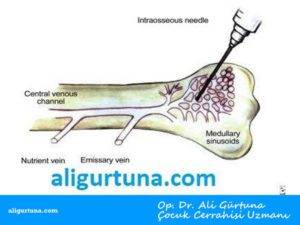 İnterosseöz Kateter Uygulaması
