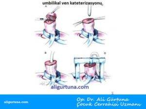 Umbilikal Ven Kateterizasyonu