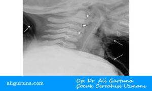Çocuklarda spontan mediastinum lateral boyun grafisi