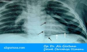 Çocuklarda spontan mediastinum akciğer grafisi